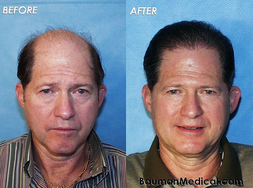 Post image for 10 Things to Consider regarding Hair Replacement