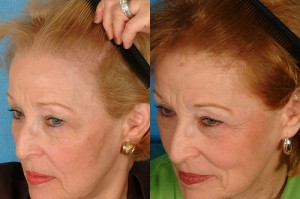 Post image for Non surgical hair replacement in women and precautions about Rogaine