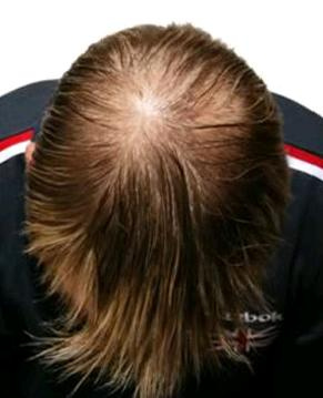 Post image for How to Plan For A Surgical Hair Replacement Procedure