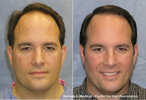 Post image for The Benefits and Risks of Hair Replacement Surgery