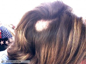 Post image for Hair replacement to correct Trichotillomania